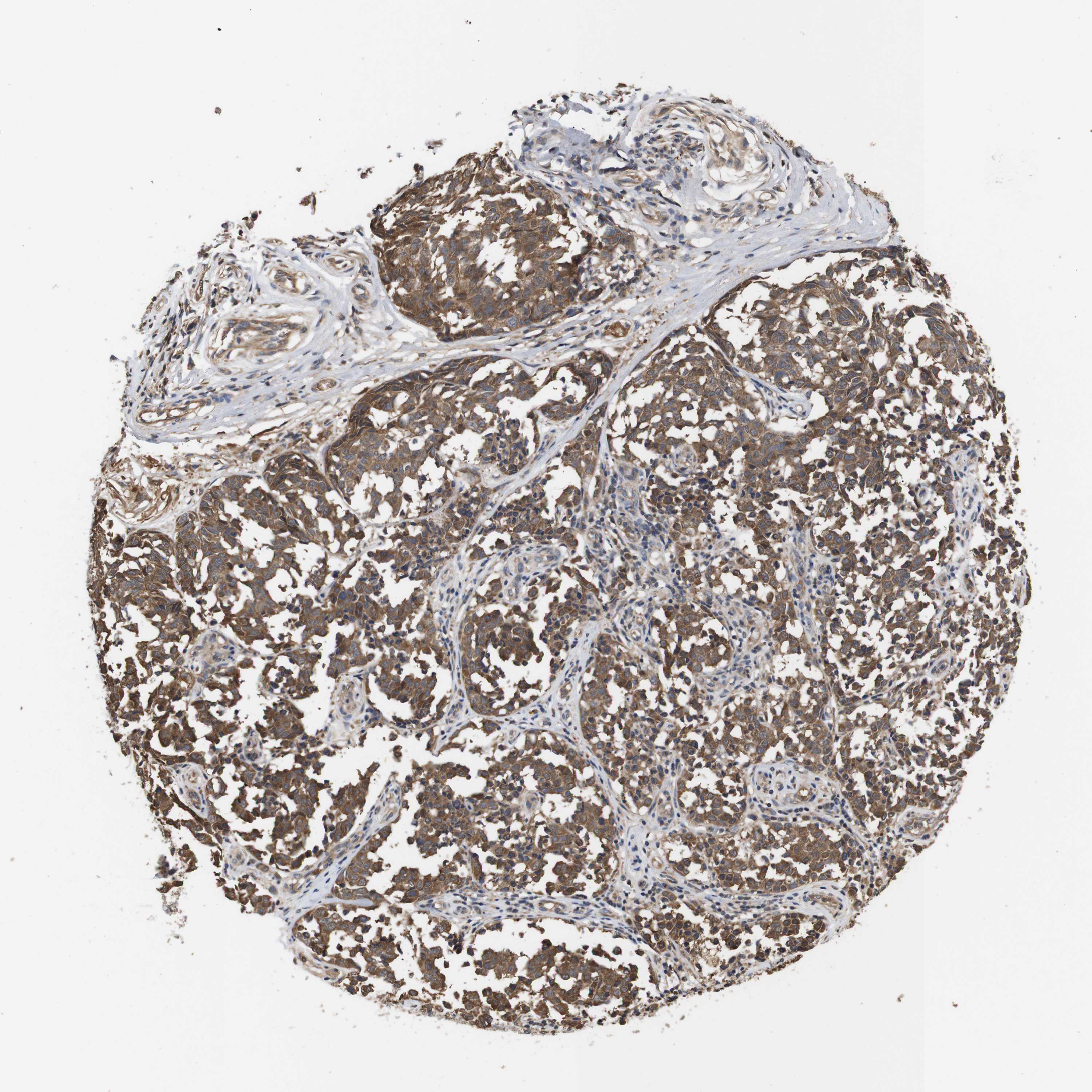Expression of DDR1 in melanoma The Human Protein Atlas