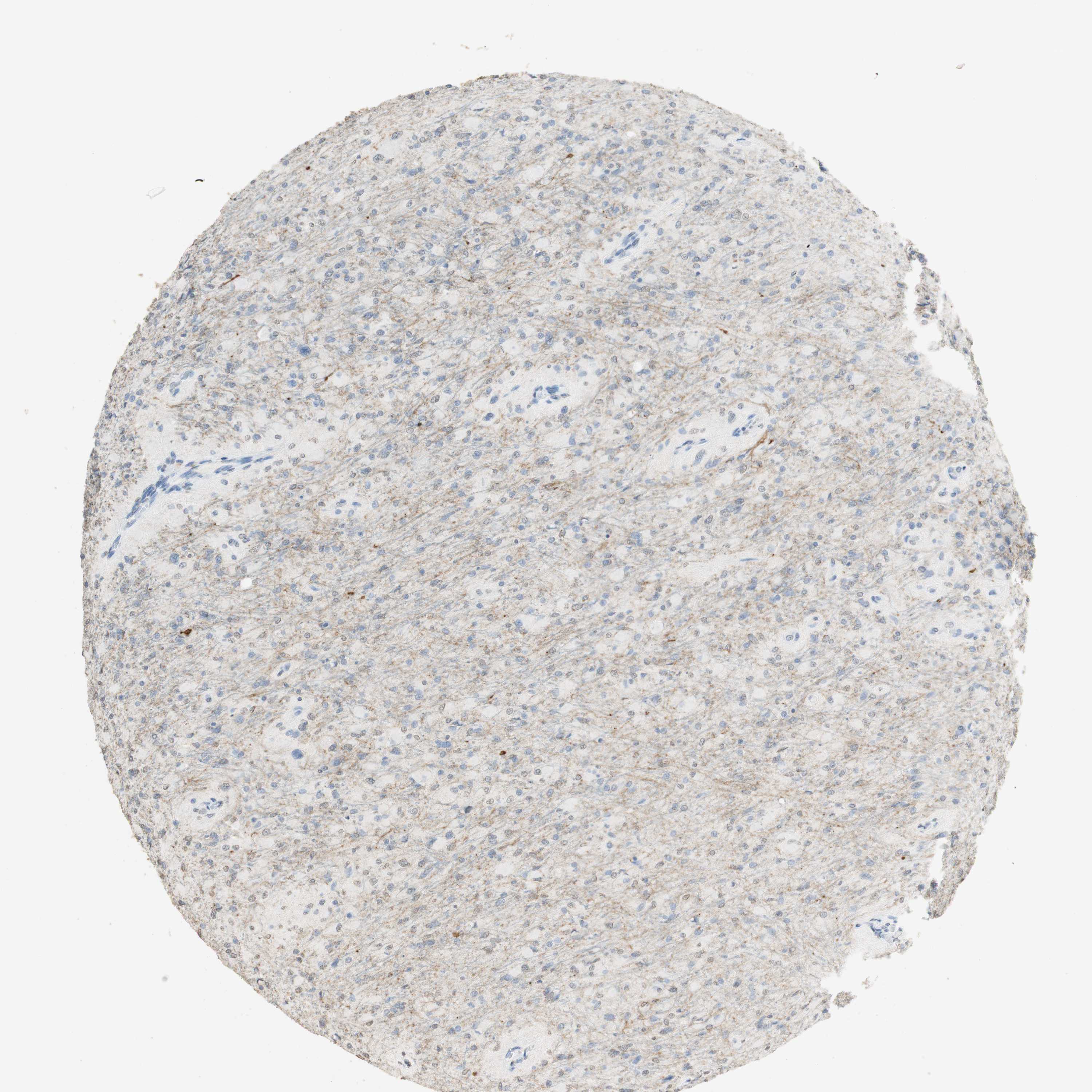 Expression of L1CAM in glioma The Human Protein Atlas
