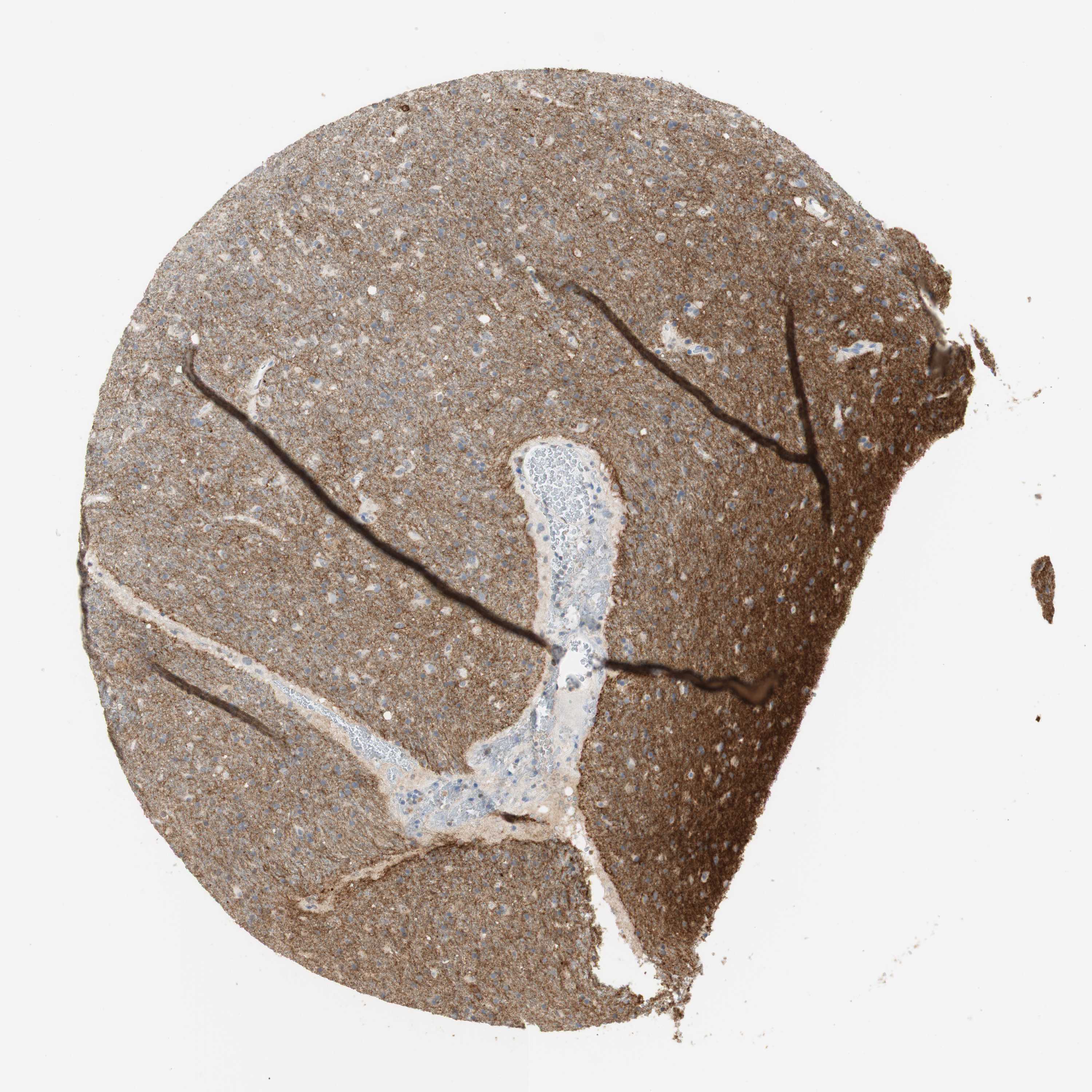 Expression of L1CAM in glioma The Human Protein Atlas