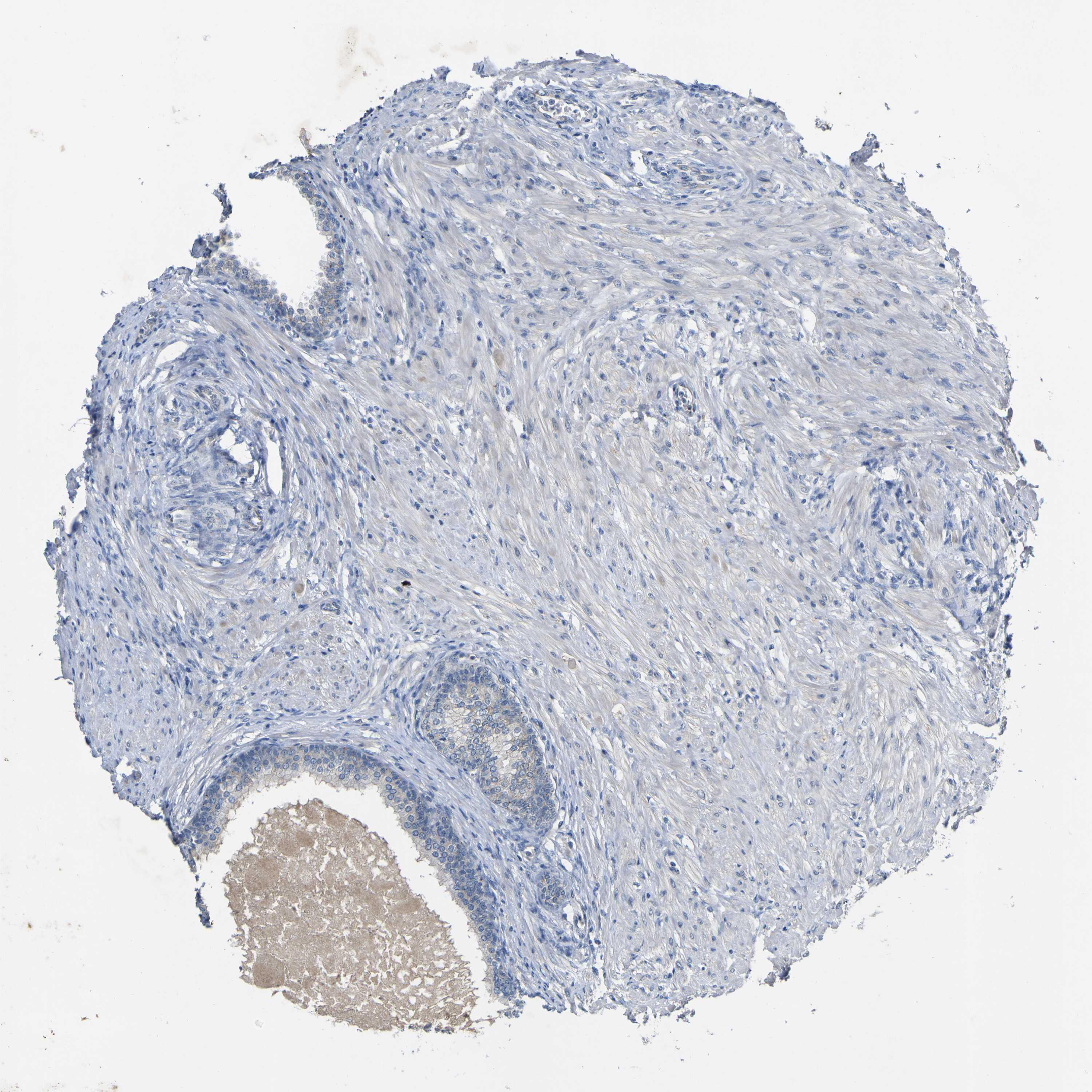 Tissue expression of LDLR Staining in prostate The Human Protein Atlas