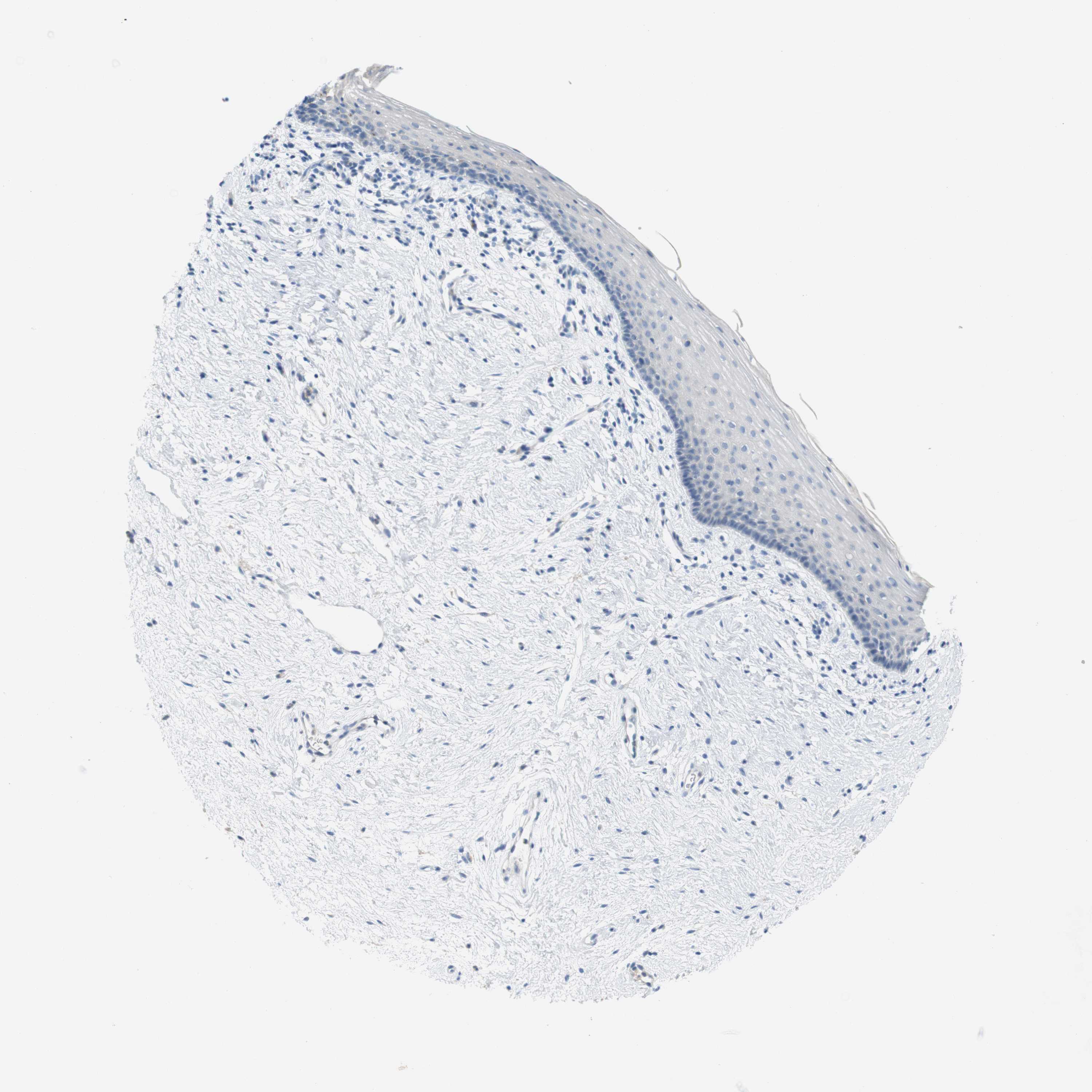 Tissue expression of LRRK2 Staining in vagina The Human Protein Atlas