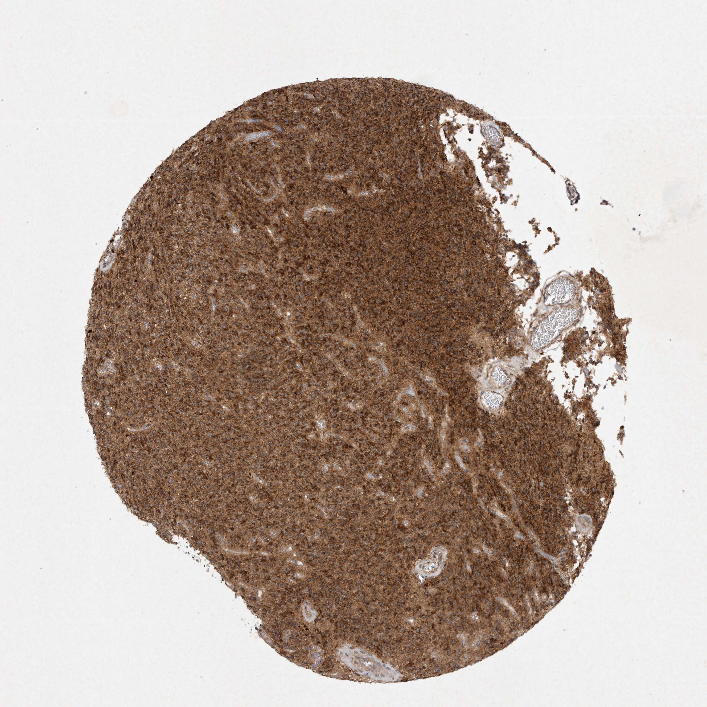 Expression of DDR1 in glioma The Human Protein Atlas