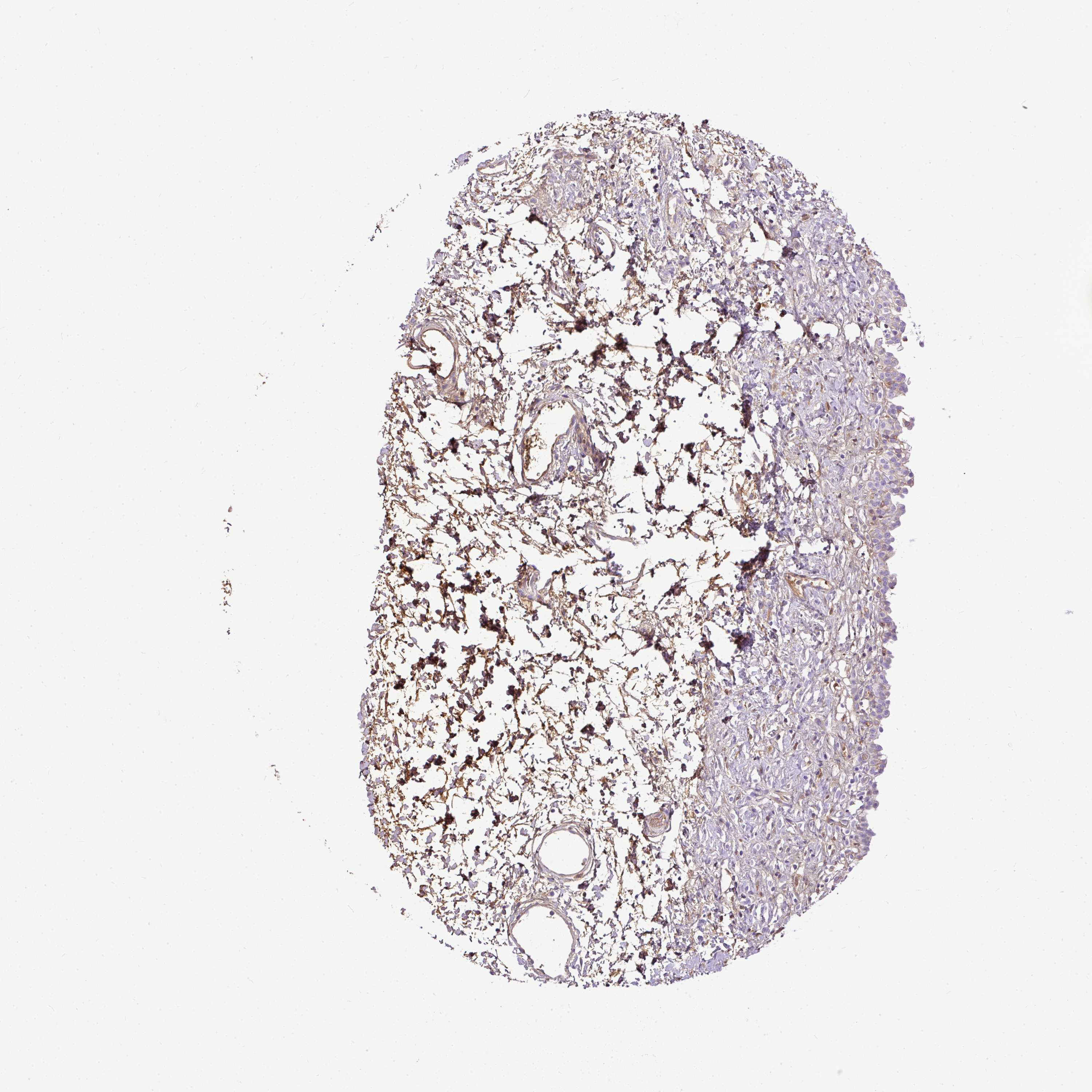 tissue fragments in urine
