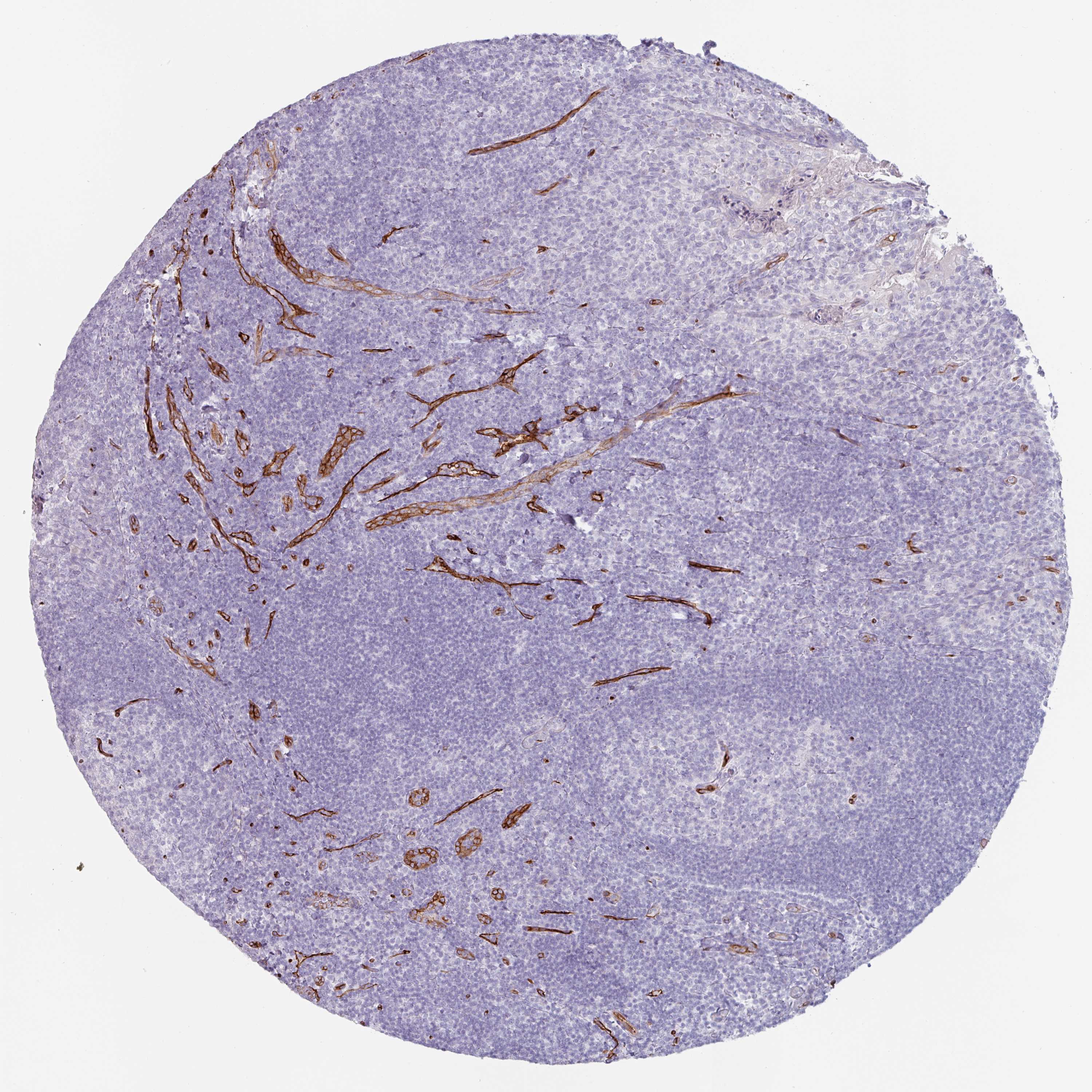 Tissue expression of CD34 Staining in tonsil The Human Protein Atlas