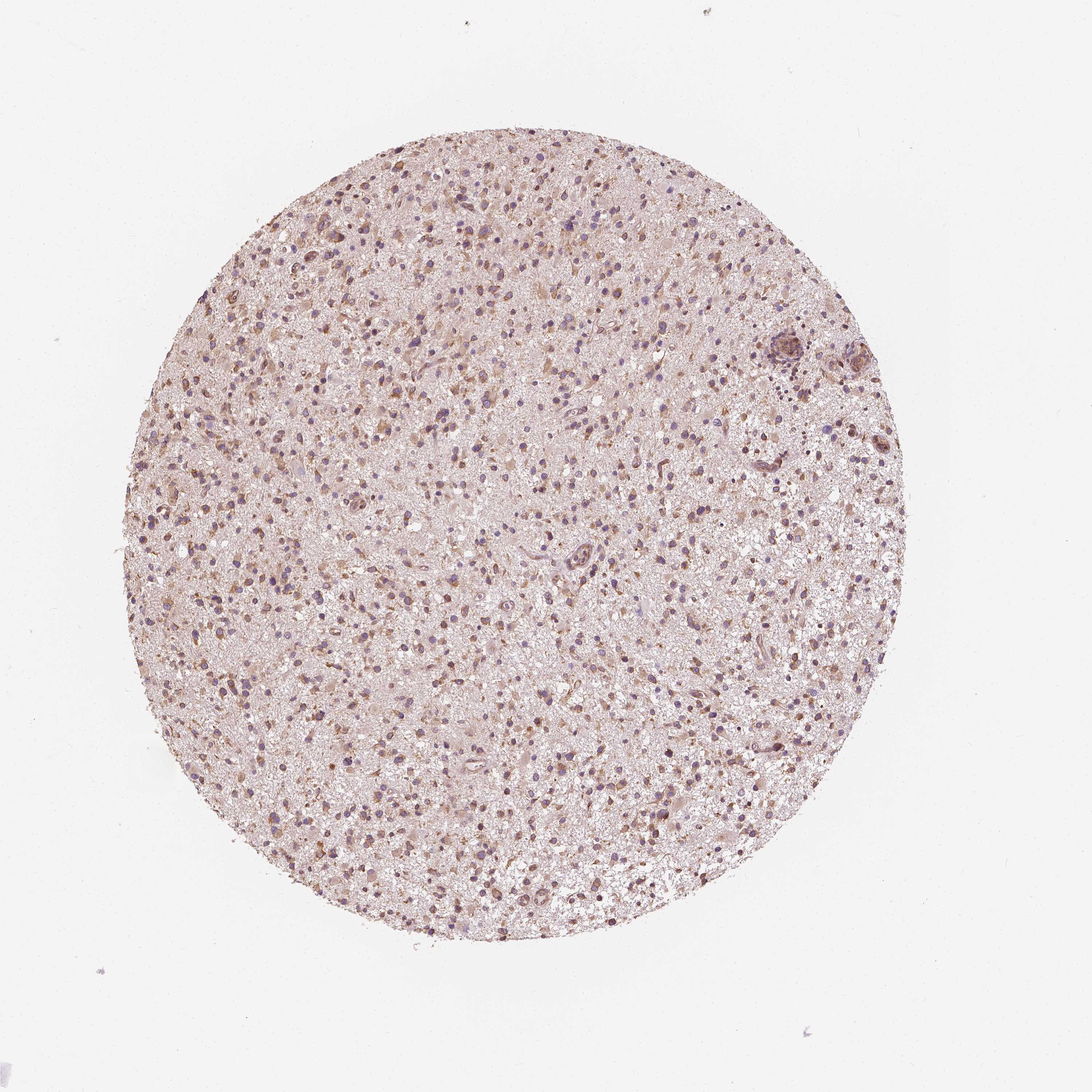 Expression of G3BP1 in glioma The Human Protein Atlas