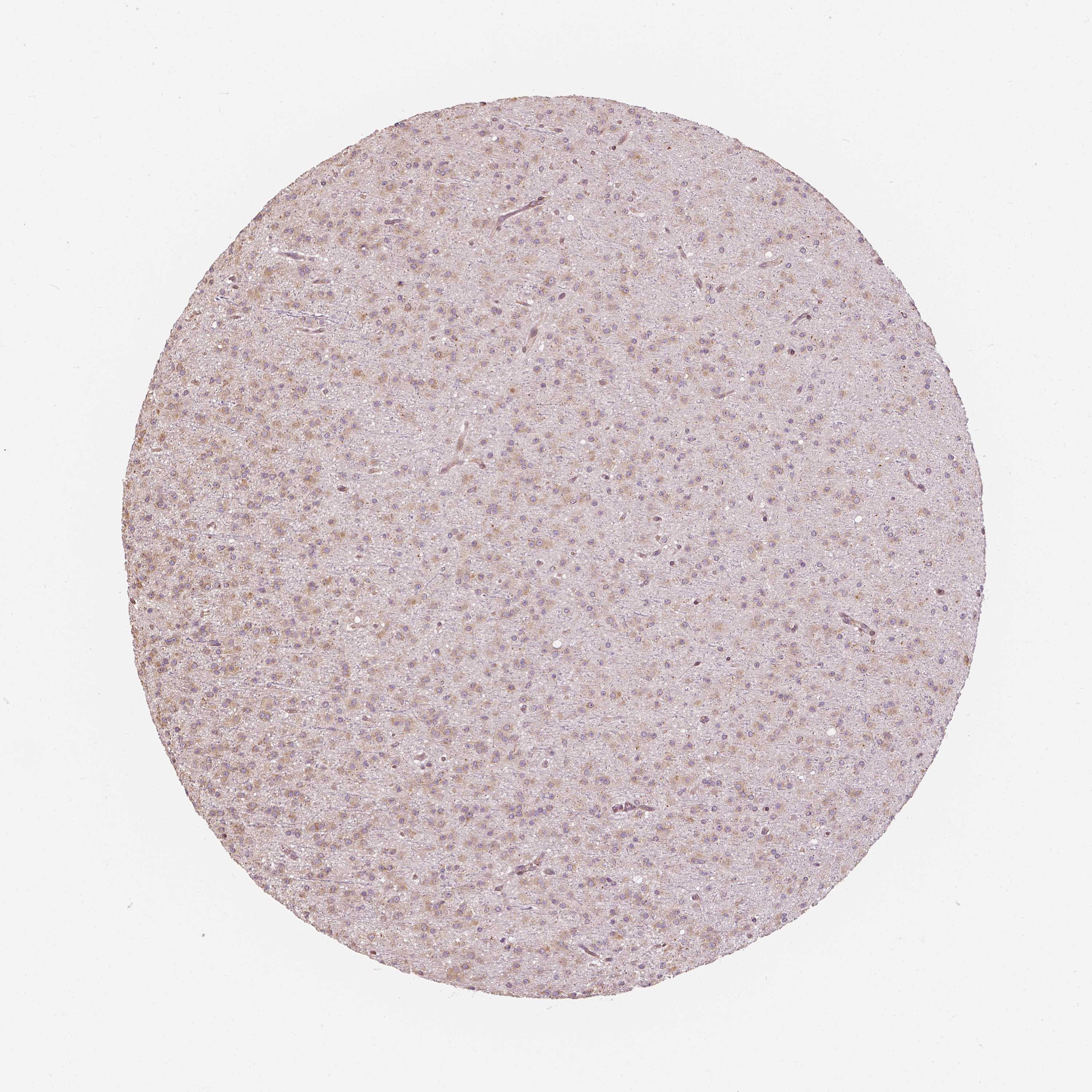 Expression of G3BP1 in glioma The Human Protein Atlas