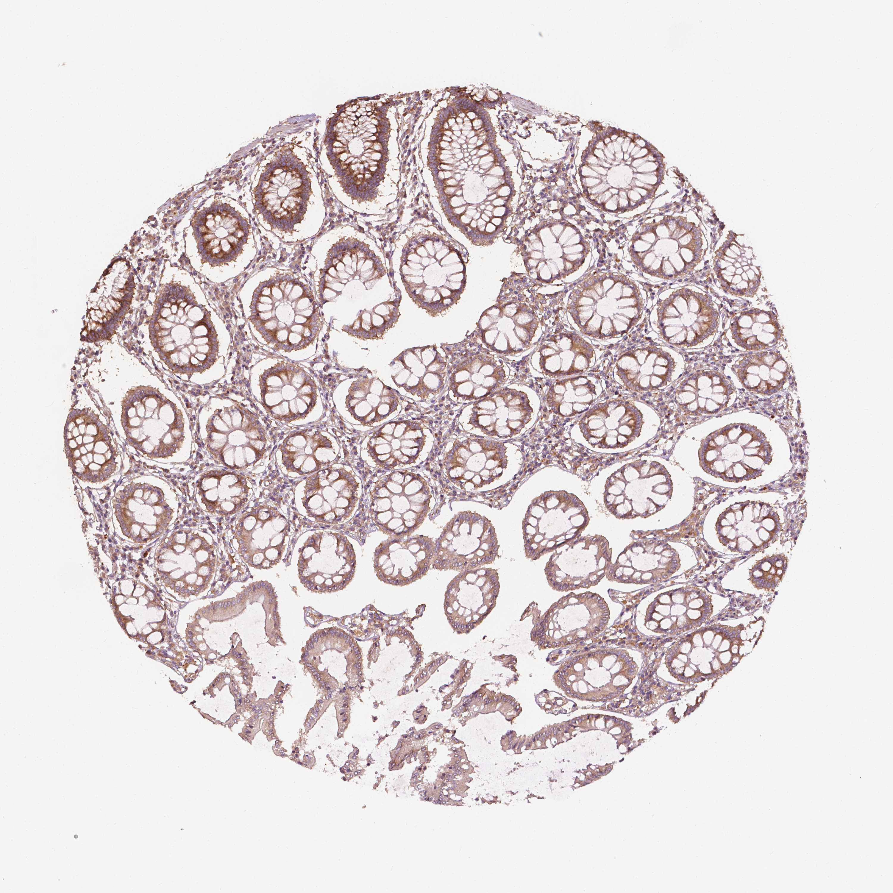 Tissue expression of G3BP1 Staining in colon The Human Protein Atlas