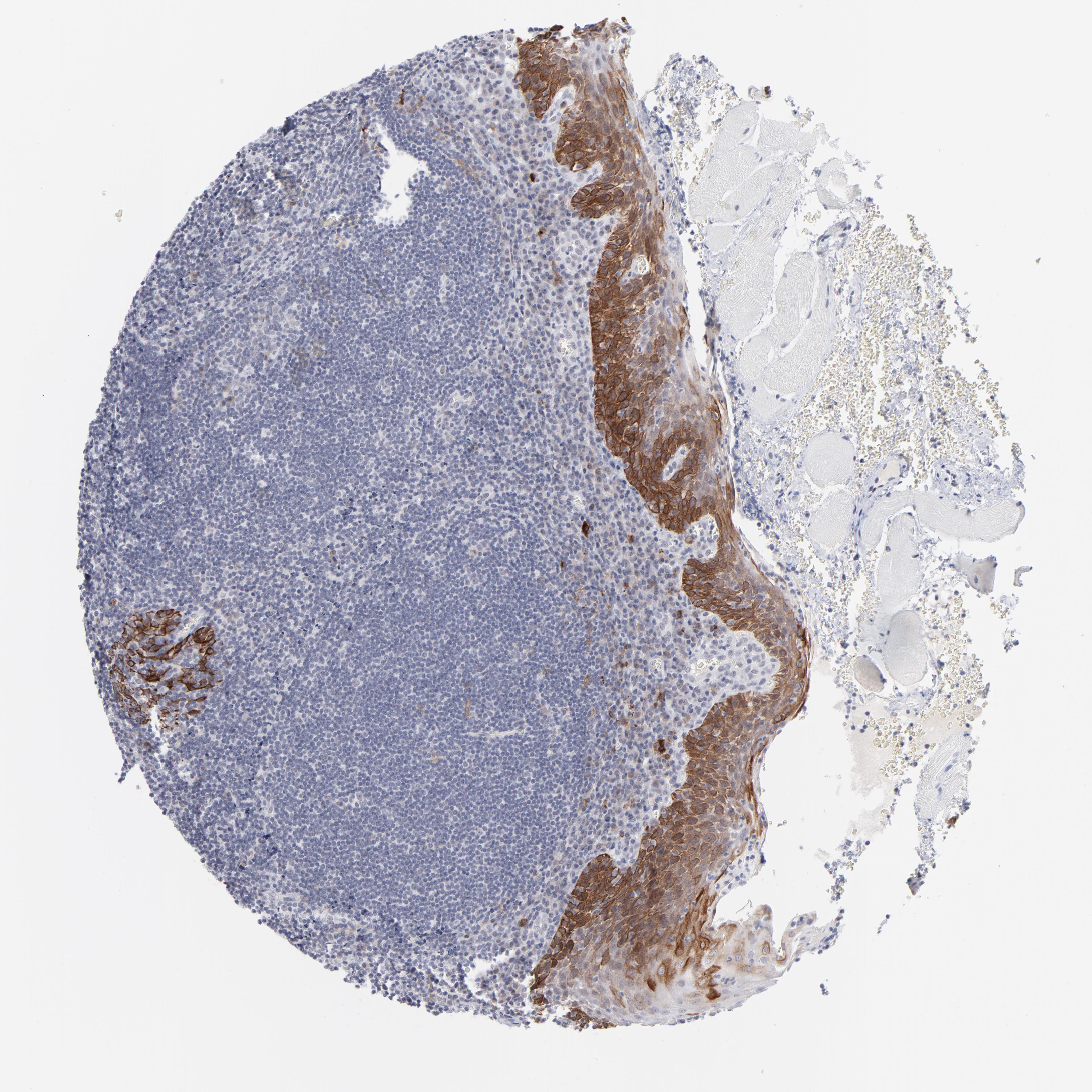 Tissue expression of CCR2 Staining in tonsil The Human Protein Atlas