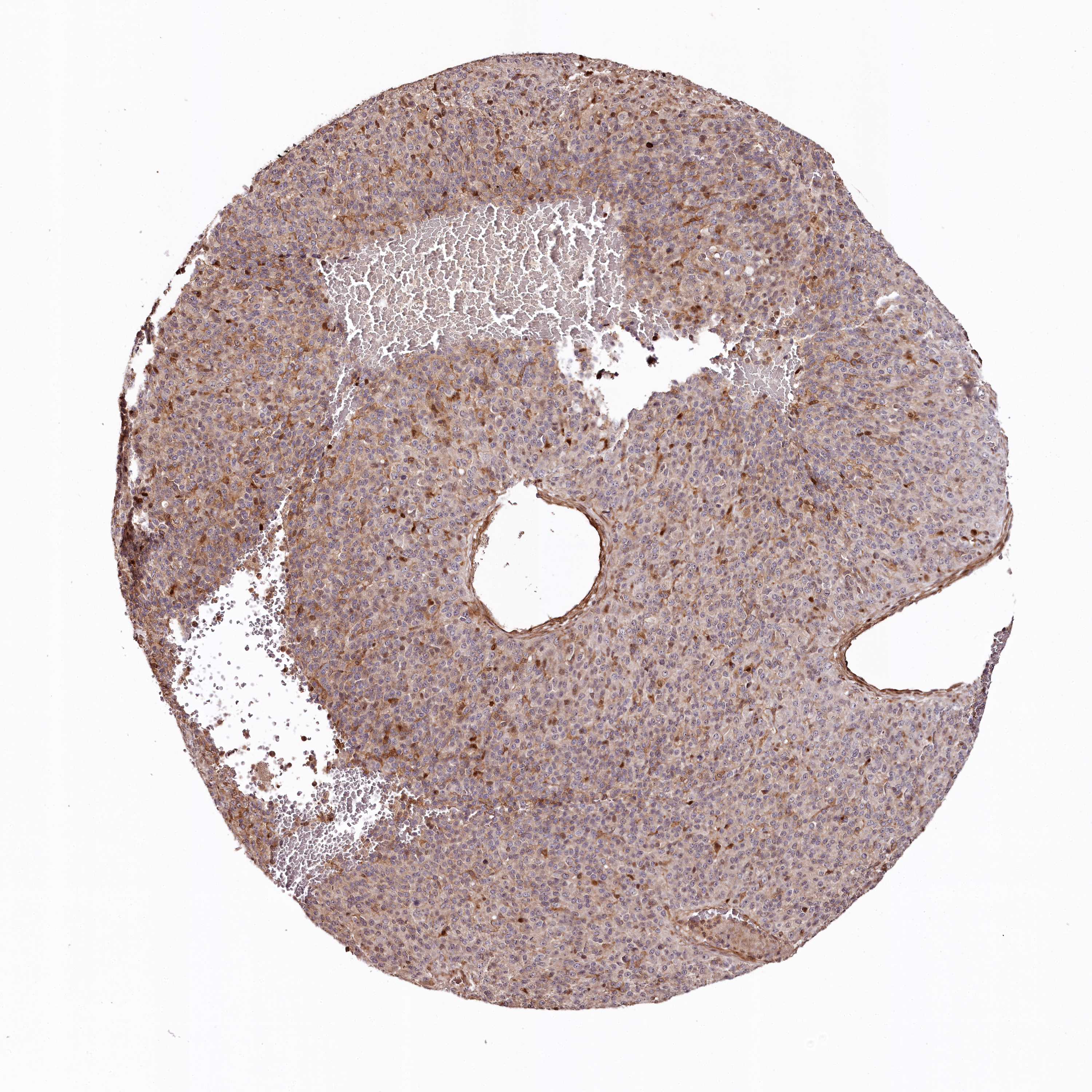 Expression of KIF14 in melanoma The Human Protein Atlas