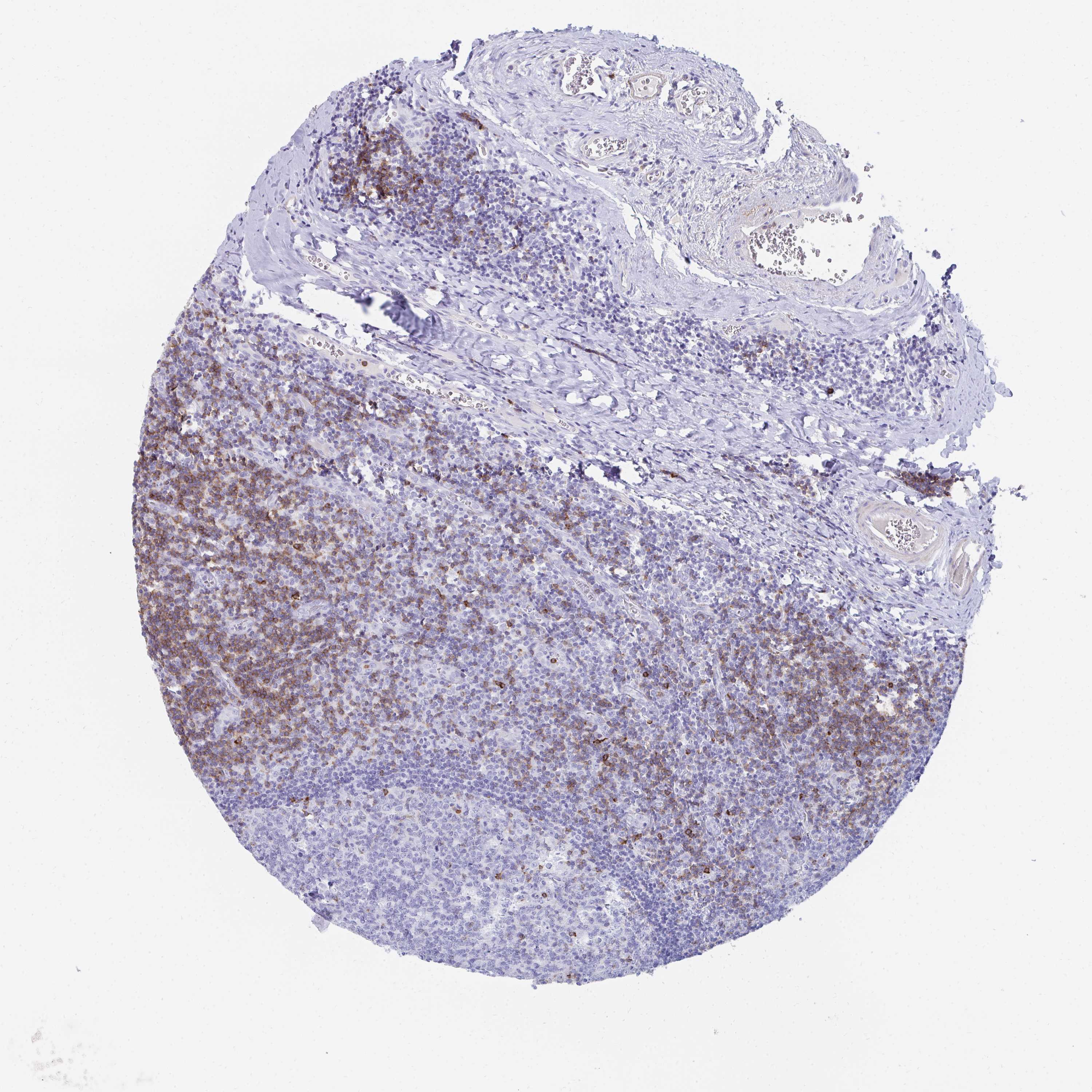 Tissue expression of CD7 Staining in tonsil The Human Protein Atlas
