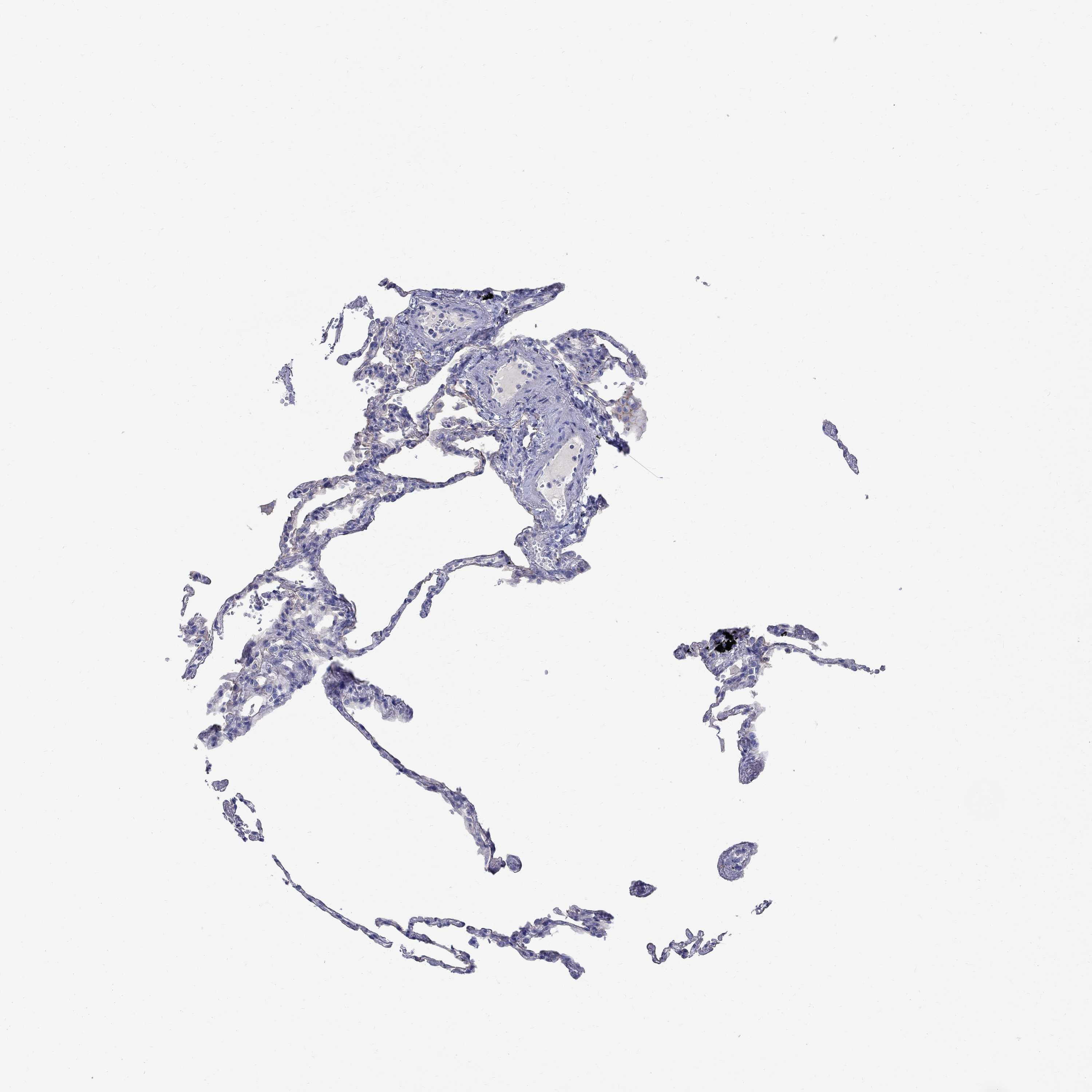 Tissue expression of SOX2 Staining in lung The Human Protein Atlas