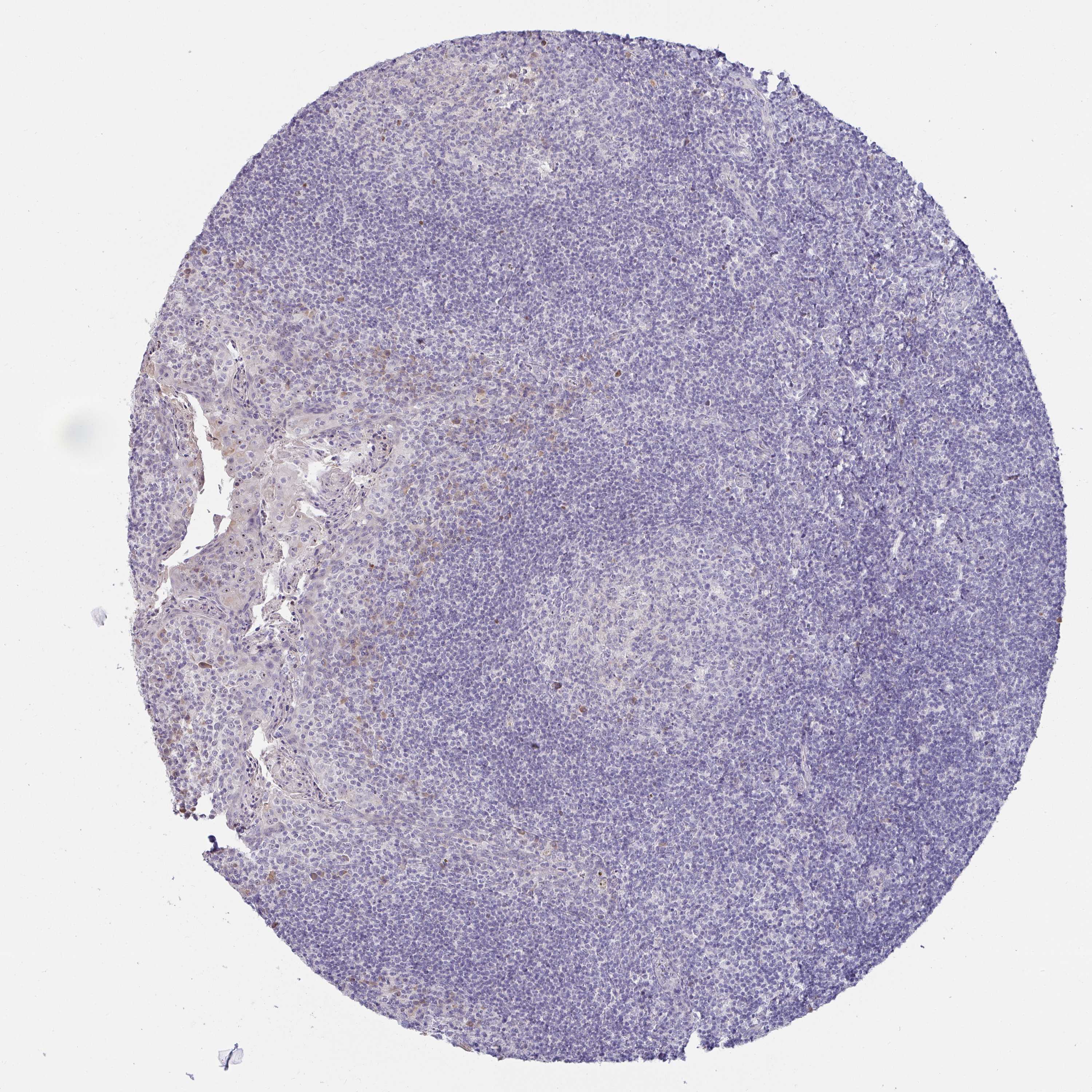 Tissue expression of MYC Staining in tonsil The Human Protein Atlas
