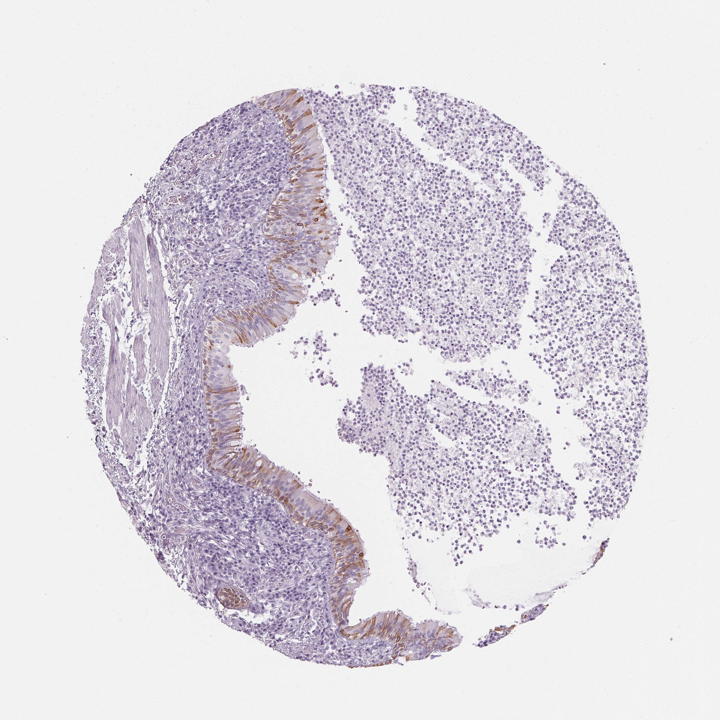 Tissue expression of KRT6A Staining in bronchus The Human Protein Atlas