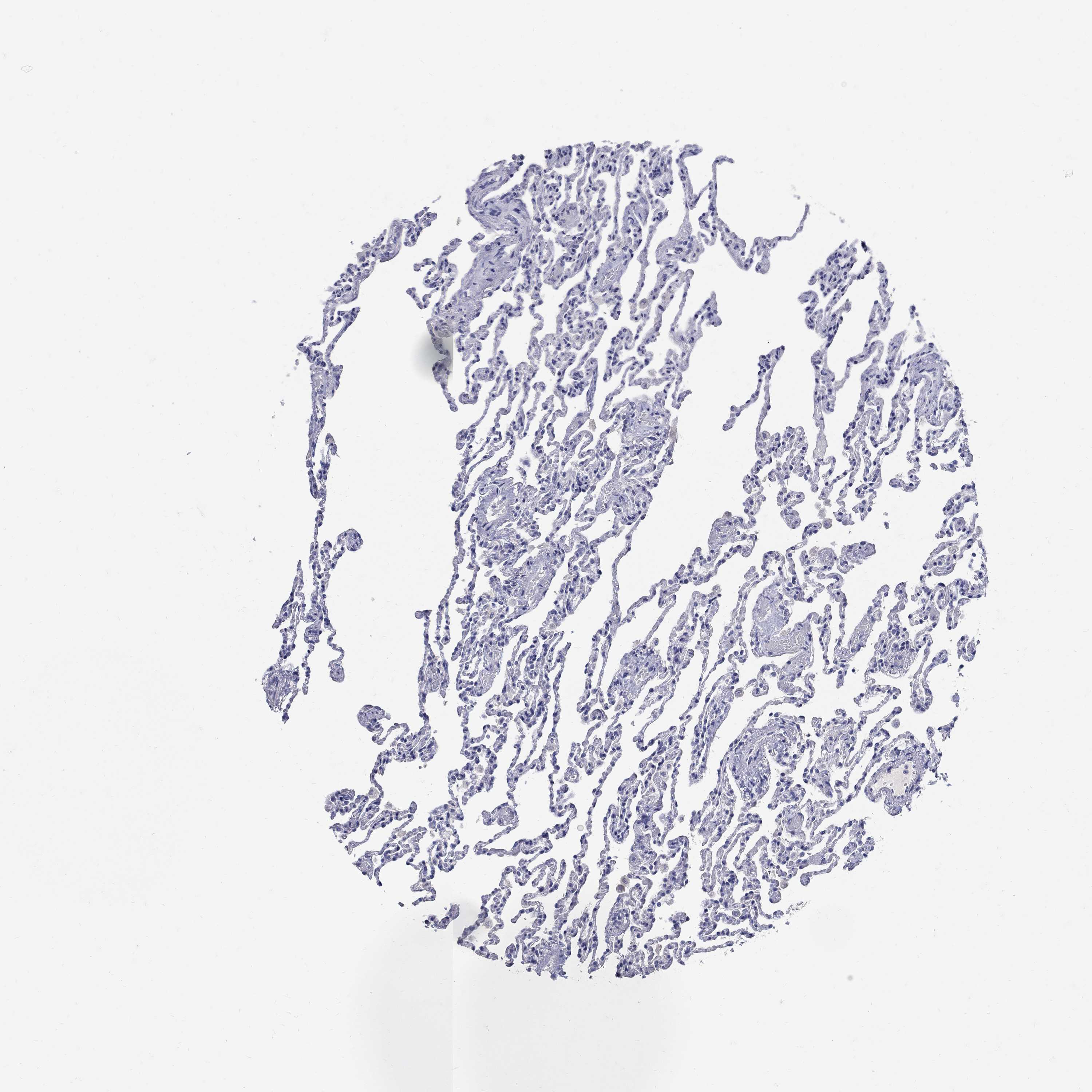 Tissue expression of SOX2 Staining in lung The Human Protein Atlas