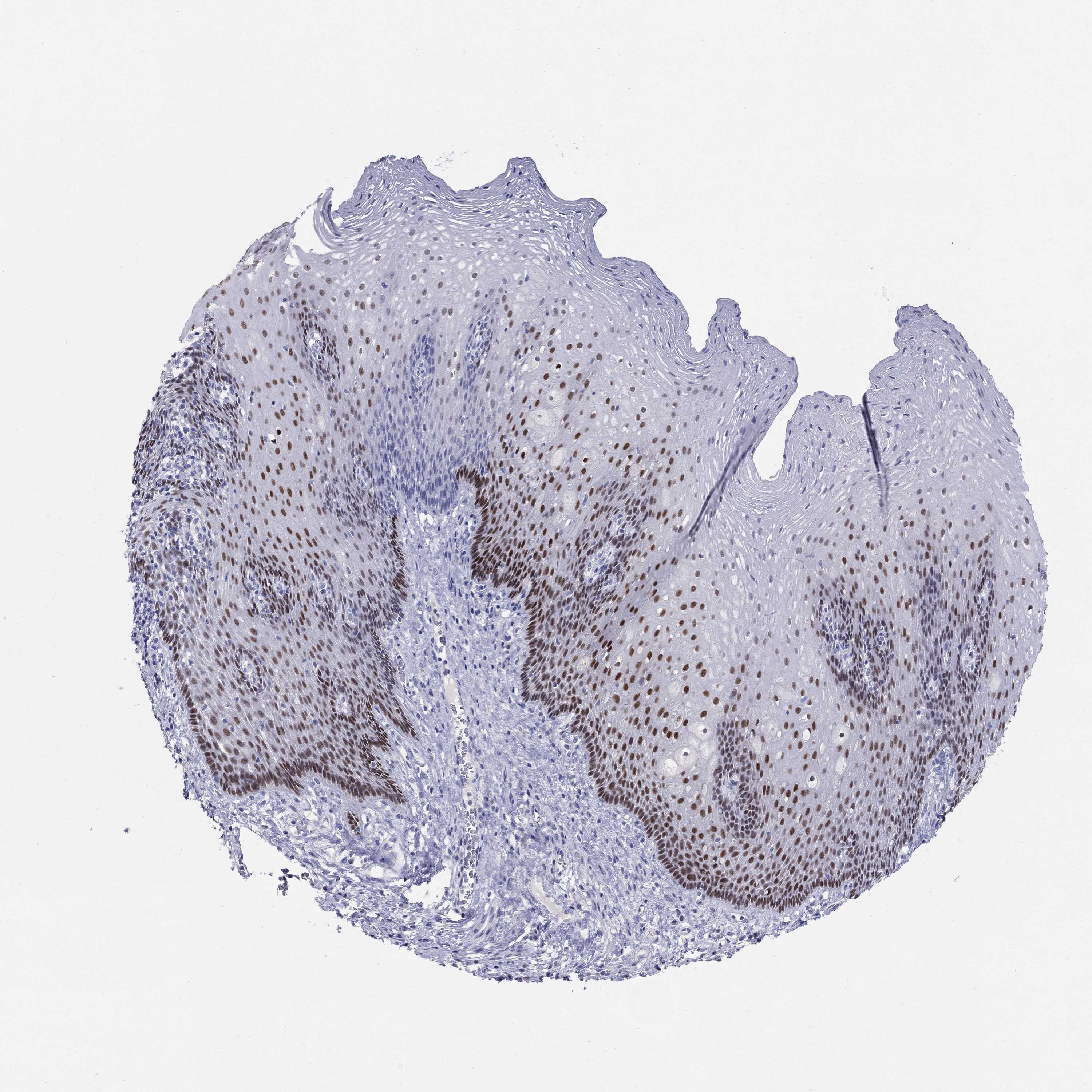 Tissue expression of SOX2 Staining in esophagus The Human Protein Atlas