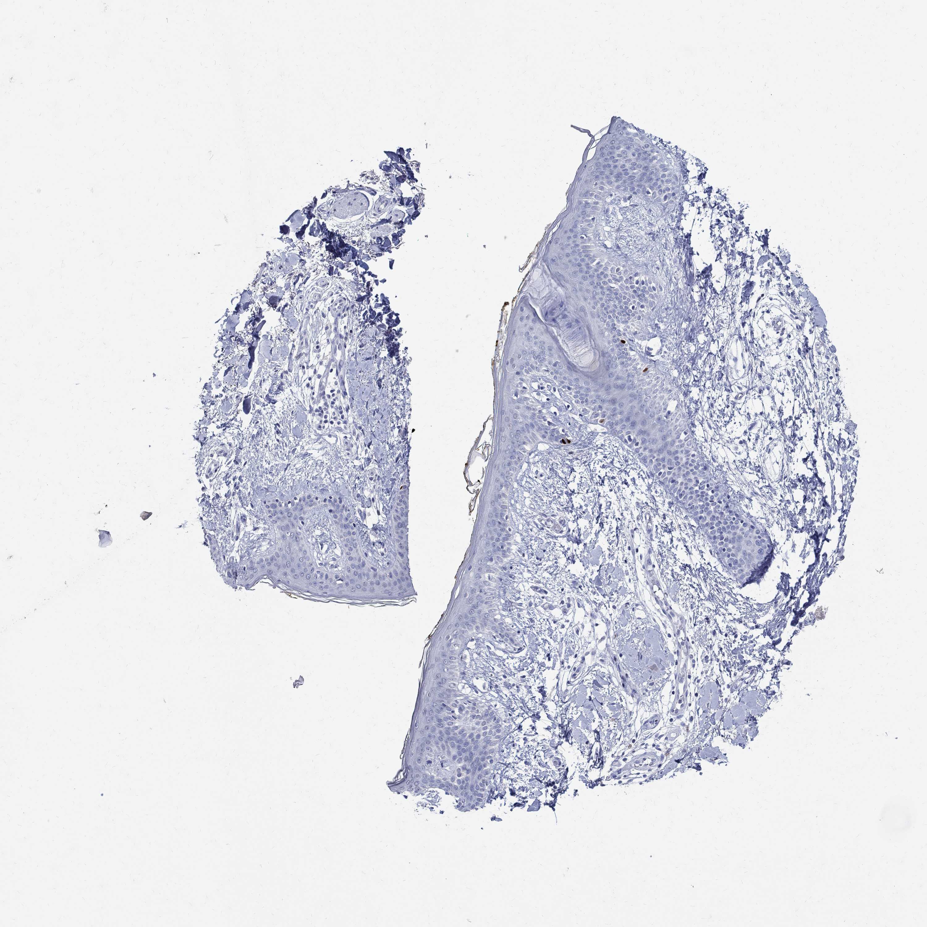 Tissue expression of SOX2 Staining in skin The Human Protein Atlas